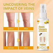 Bees Venom Varicose Veins Spray(Pack of 3)