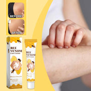 Bee Venom Vitiligo Treatment Cream