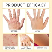 Bee Venom Vitiligo Treatment Cream, Fivfivgo Vitiligo Treatment Cream, Bee Venom Treatment Cream (Pack of 2)
