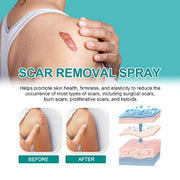 South Moon Medical Grade Scar Spray ( Pack Of 2 )