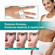South Moon Medical Grade Scar Spray ( Pack Of 2 )